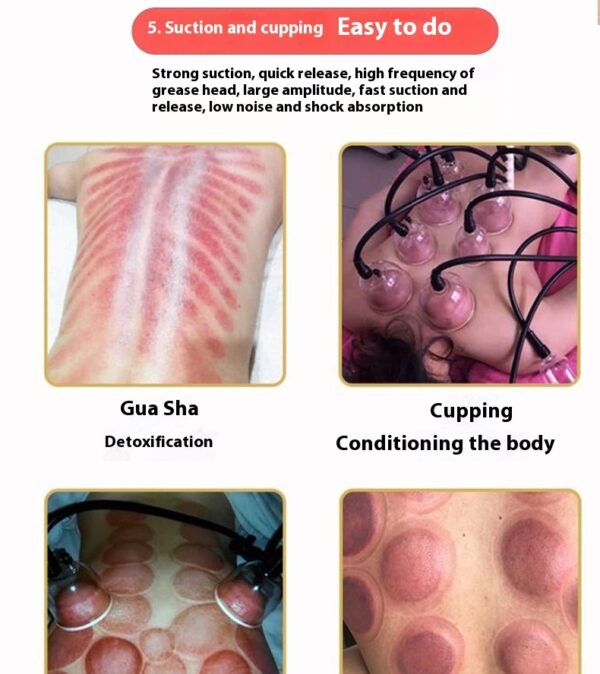 Internal Negative Pressure Health Care Scraping Cupping Electric Physiotherapy Instrument - Image 9